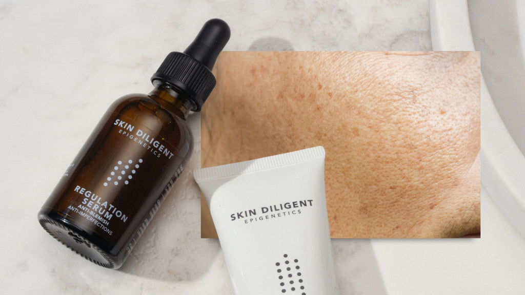Hyperpigmentation : comprendre les causes et les échecs des solutions classiques